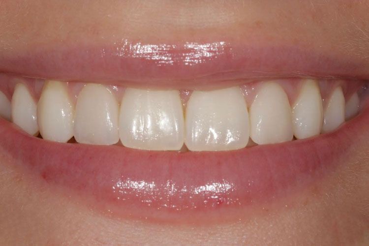 Dental veneers procedure after