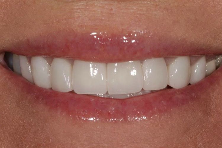 Dental veneers procedure after