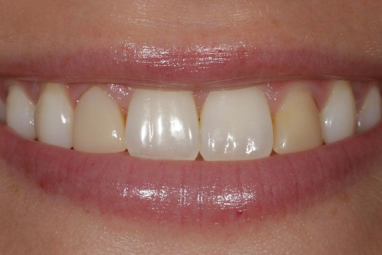 Dental veneers procedure before