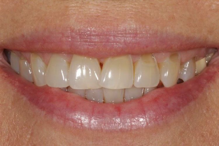 Dental veneers procedure before
