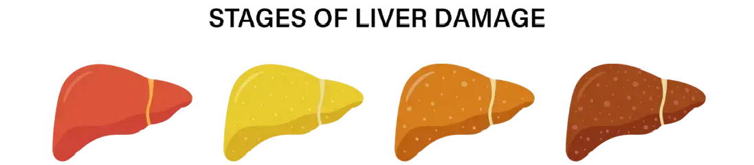 A diagram showing the stages of liver damage.