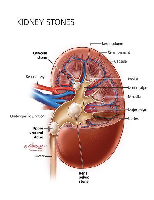 Signs You May Have Kidney Stones, Blog