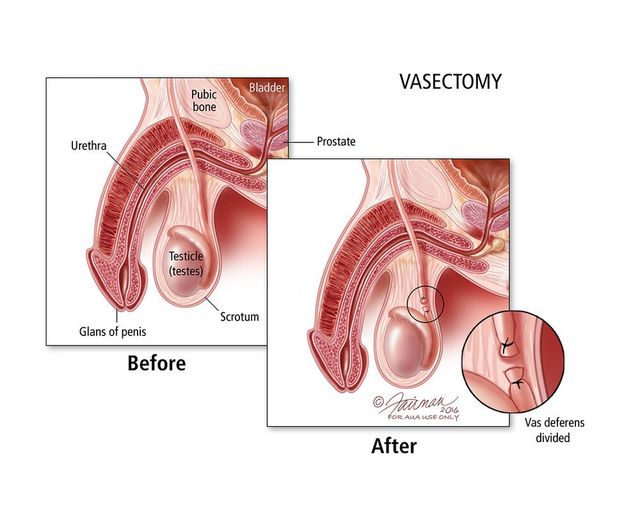 Post Vasectomy Intimacy, Metrocentre