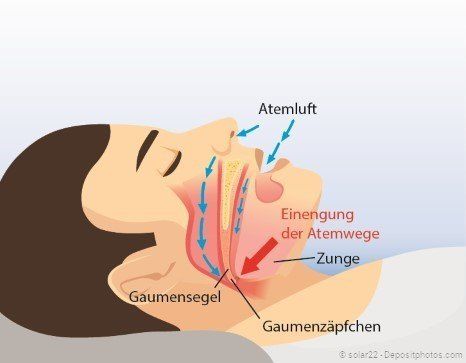 Anatomie der oberen Atemwege beim Schnarchen