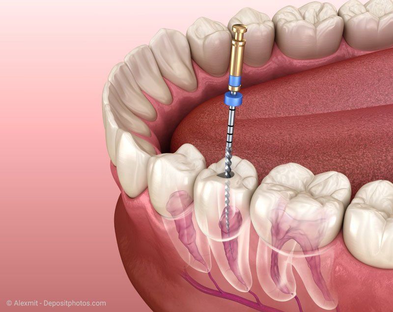 Gründlich wird das infizierte Gewebe entfernt, die Wurzelkanäle gereinigt, gespült und desinfiziert bevor der Zahn wieder verschlossen wird.