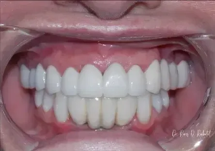 After picture of white teeth
