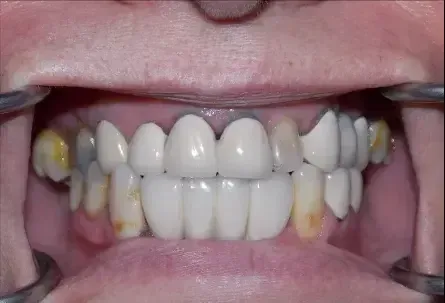 Before picture of yellow teeth