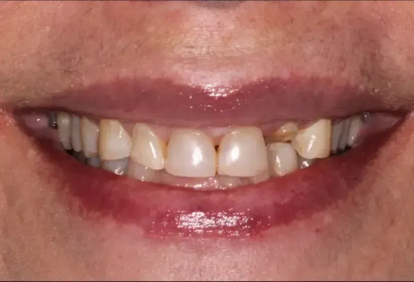 Before picture of crooked yellow teeth
