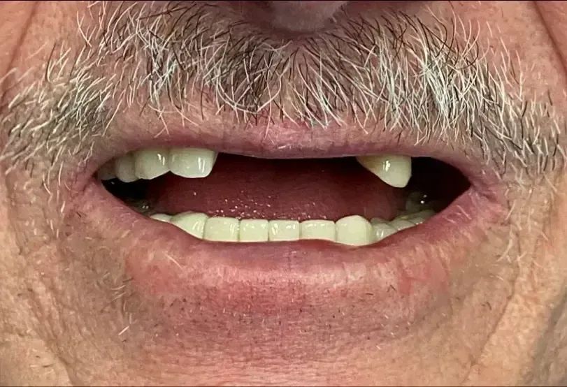 a man missing multiple front teeth