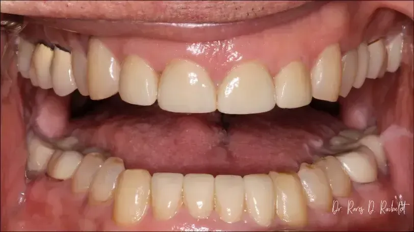 after of image of veneers