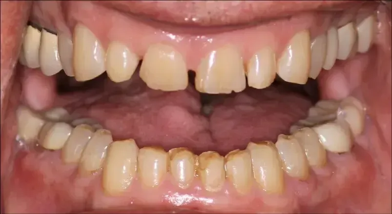 before image of yellow teeth with big gaps