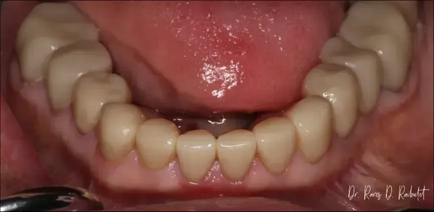 after image of cleaned teeth