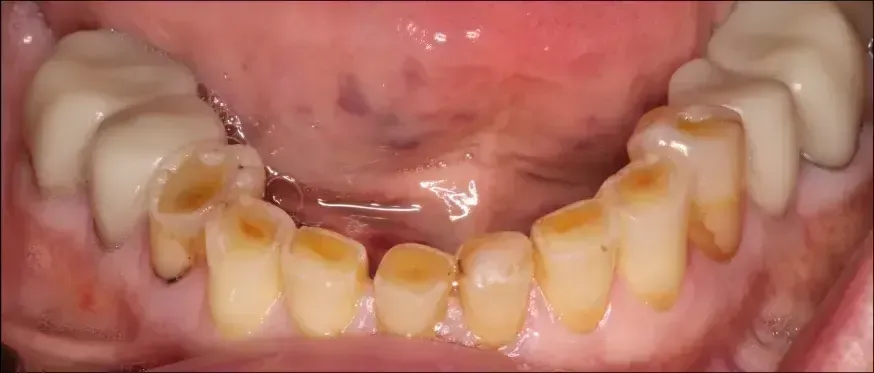 stained yellow teeth