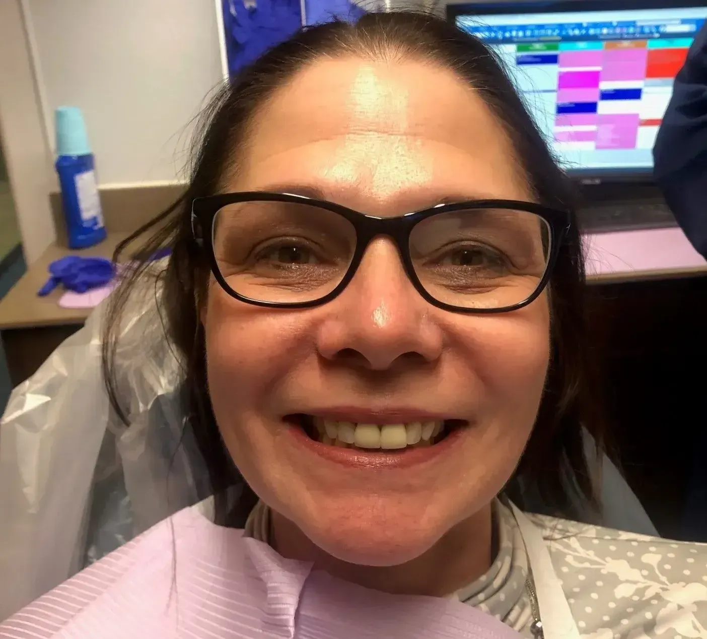 Before picture of a woman with yellow teeth