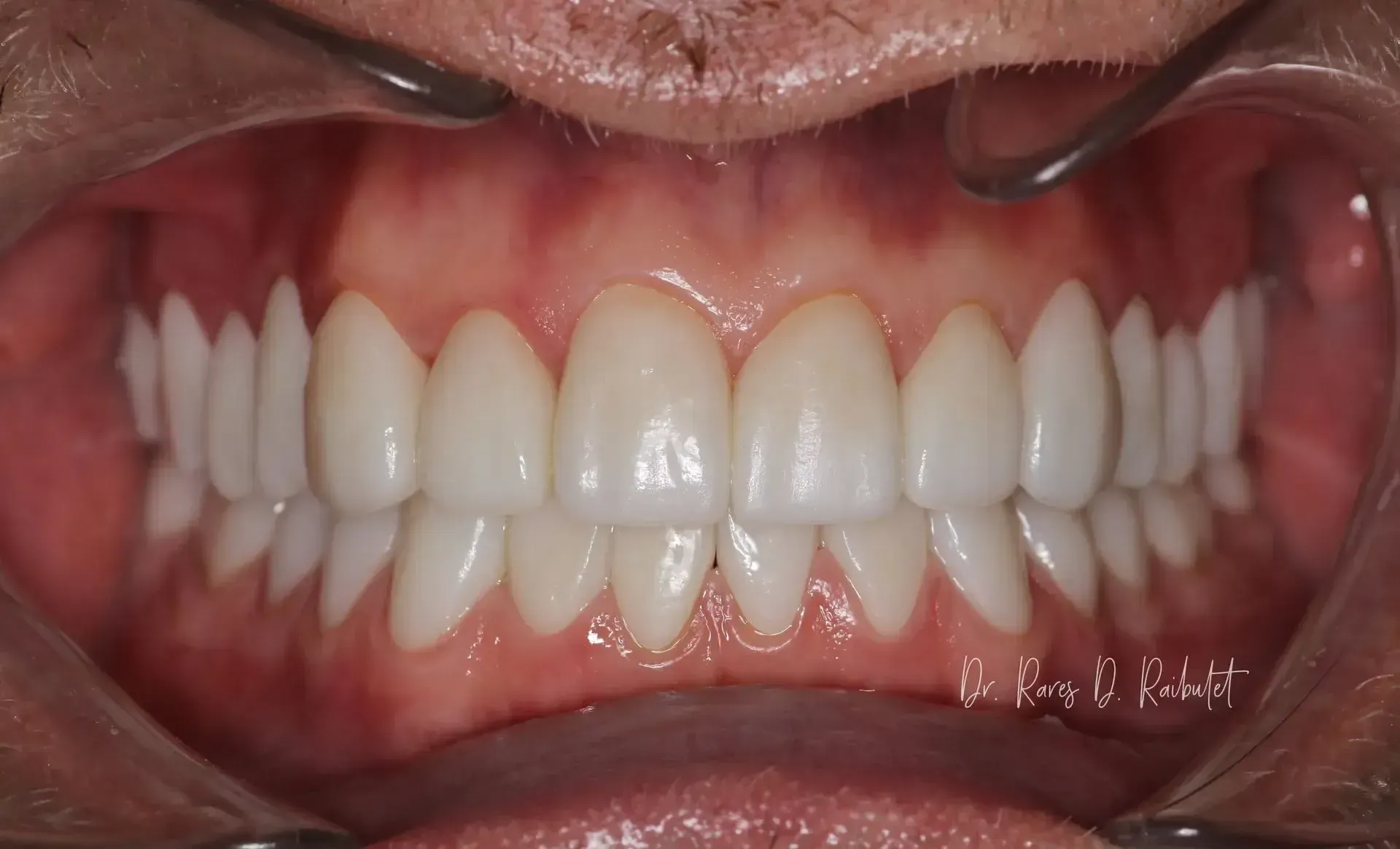 After picture of a man with white, even teeth