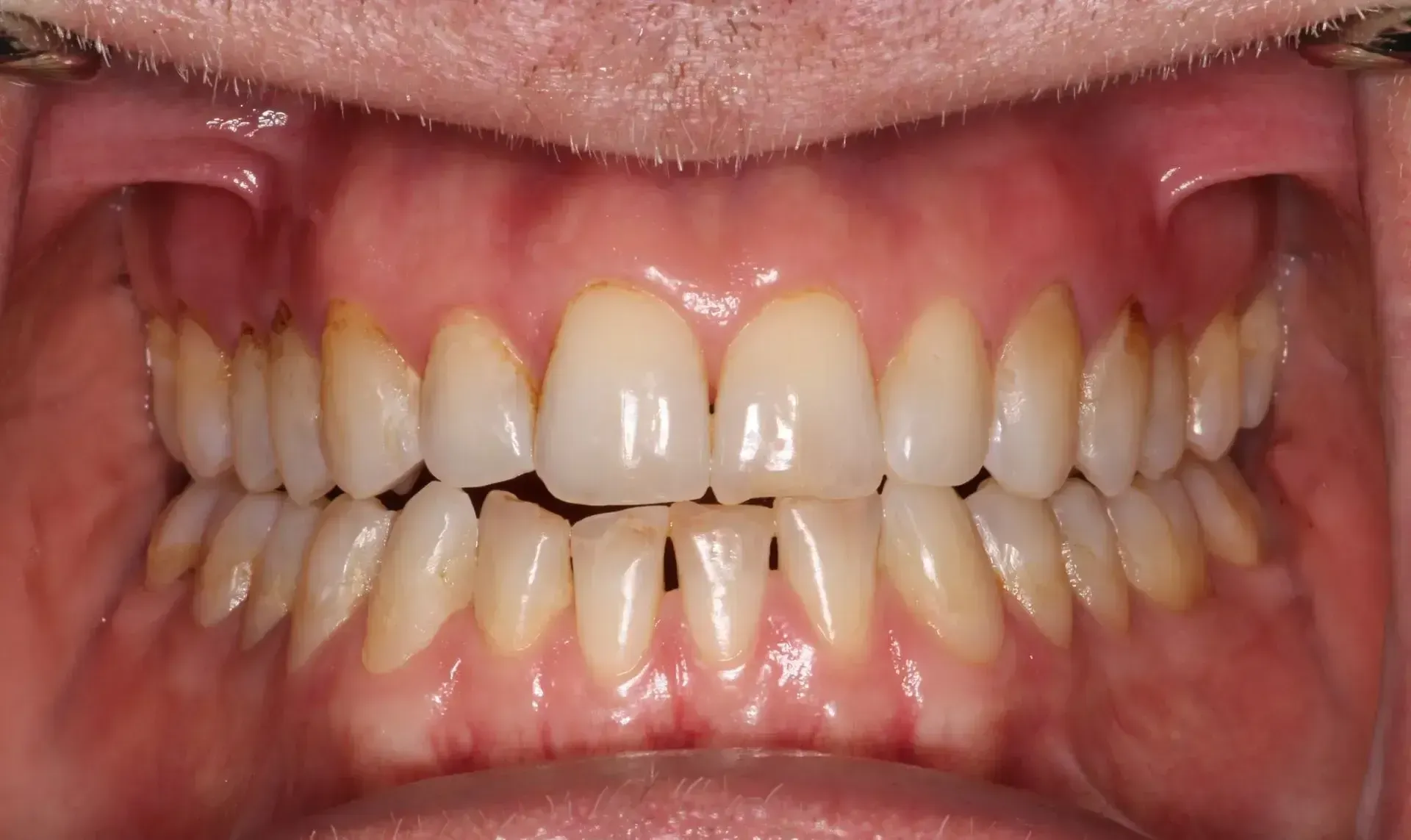 Before picture of a man with stained, yellow teeth