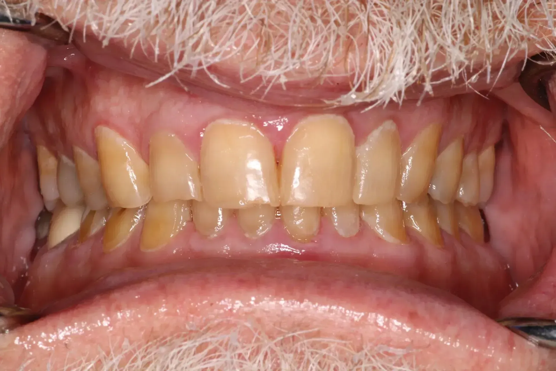 a before picture of a man with badly stained yellow teeth