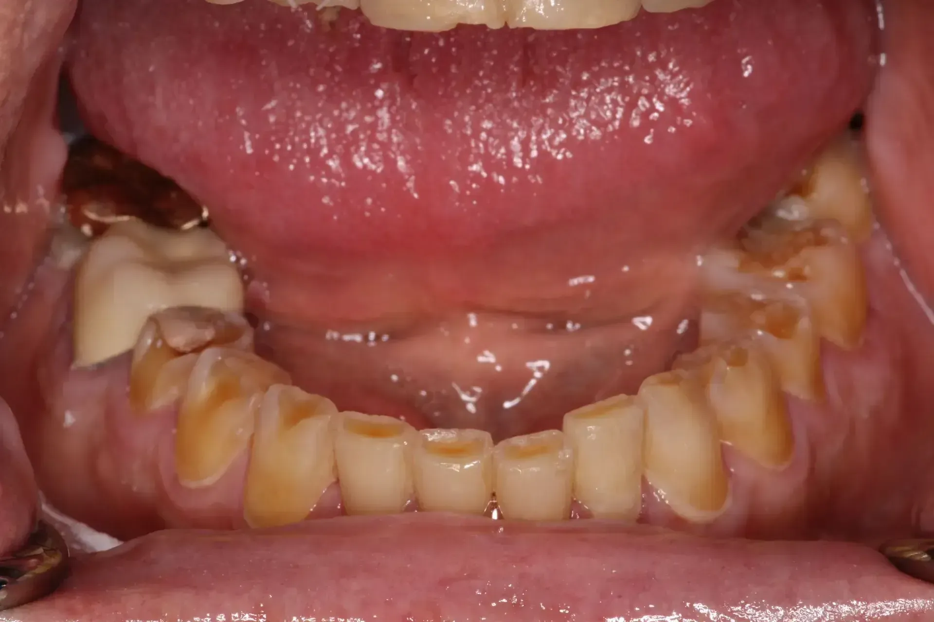 before image of yellow damaged teeth