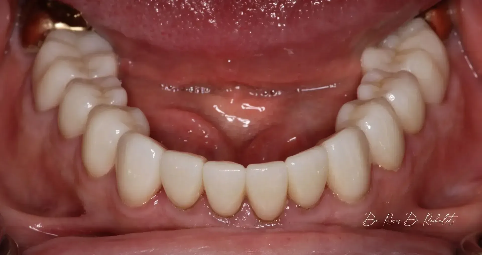 the bottom row of whitened teeth