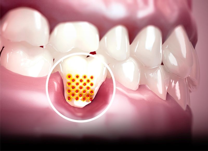 Preventing Gum Disease