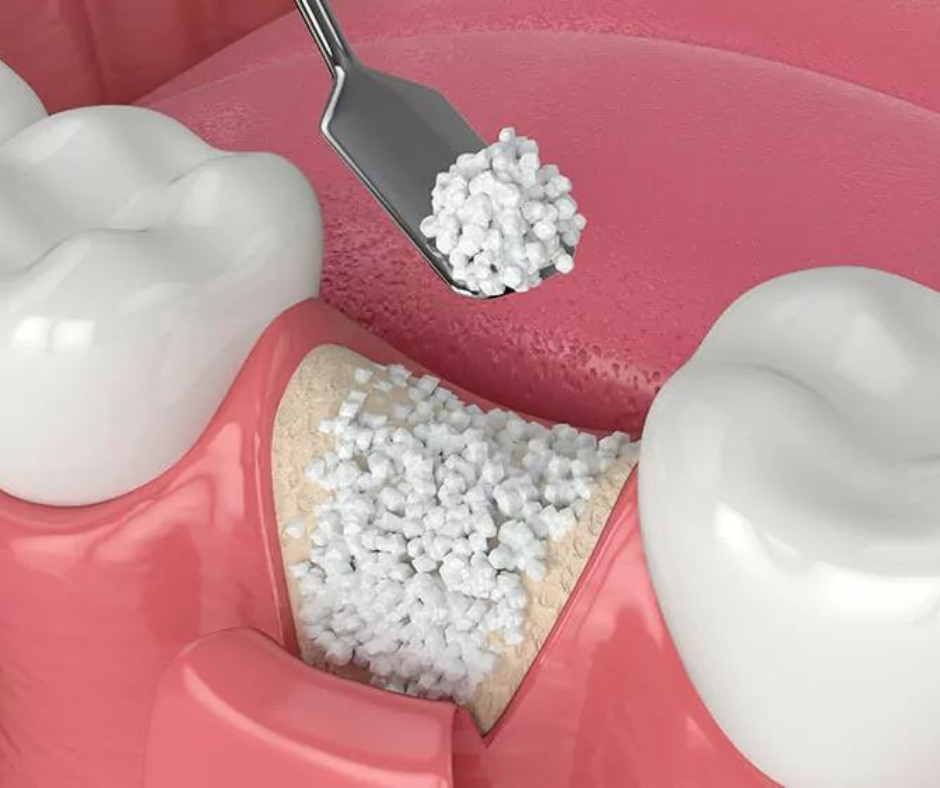 Bone Grafting | Stephens Dentistry