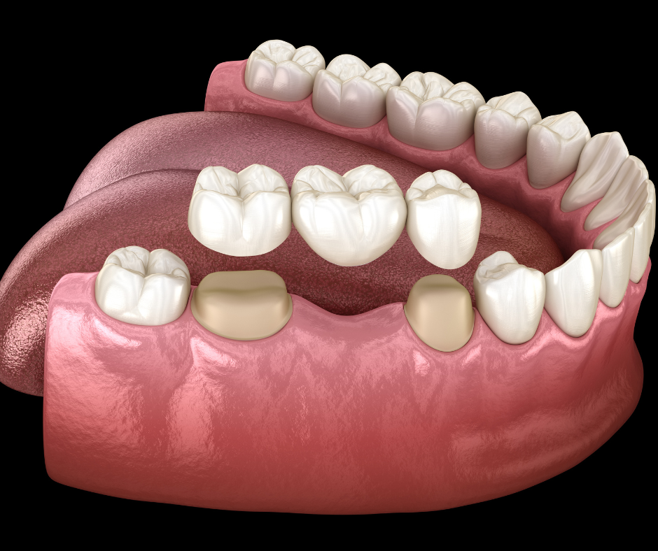 Bridges | Stephens Dentistry