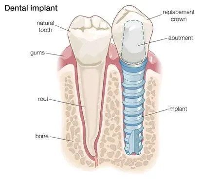 Implants & Implant Restorations | Stephens Dentistry