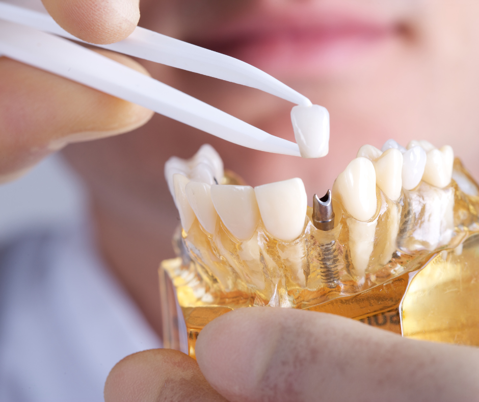Lab Created Restorations | Stephens Dentistry