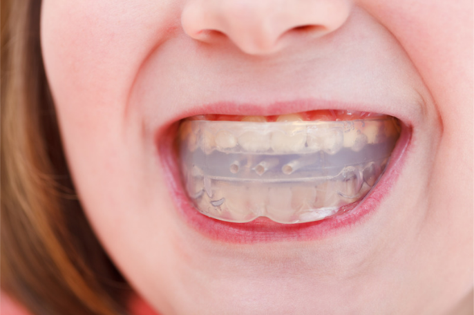 Nightguards | Stephens Dentistry