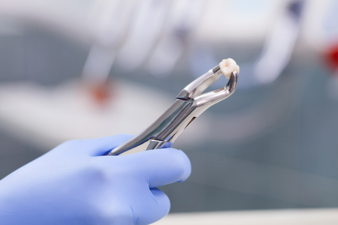 Tooth Extractions | Stephens Dentistry