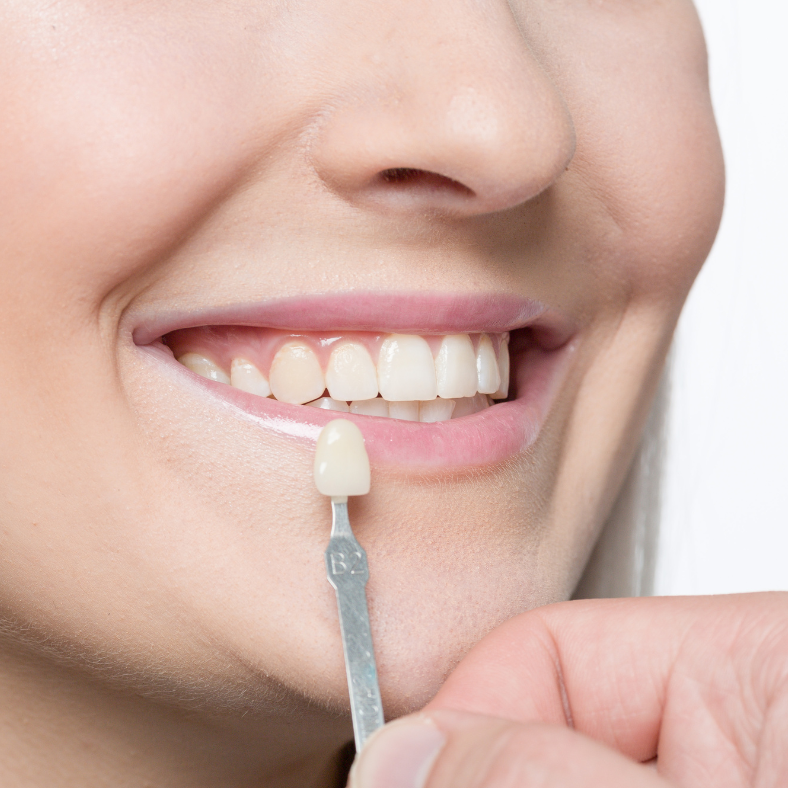Veneers | Stephens Dentistry