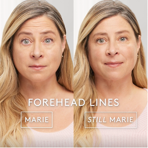 blonde female patient before and after botox treatment