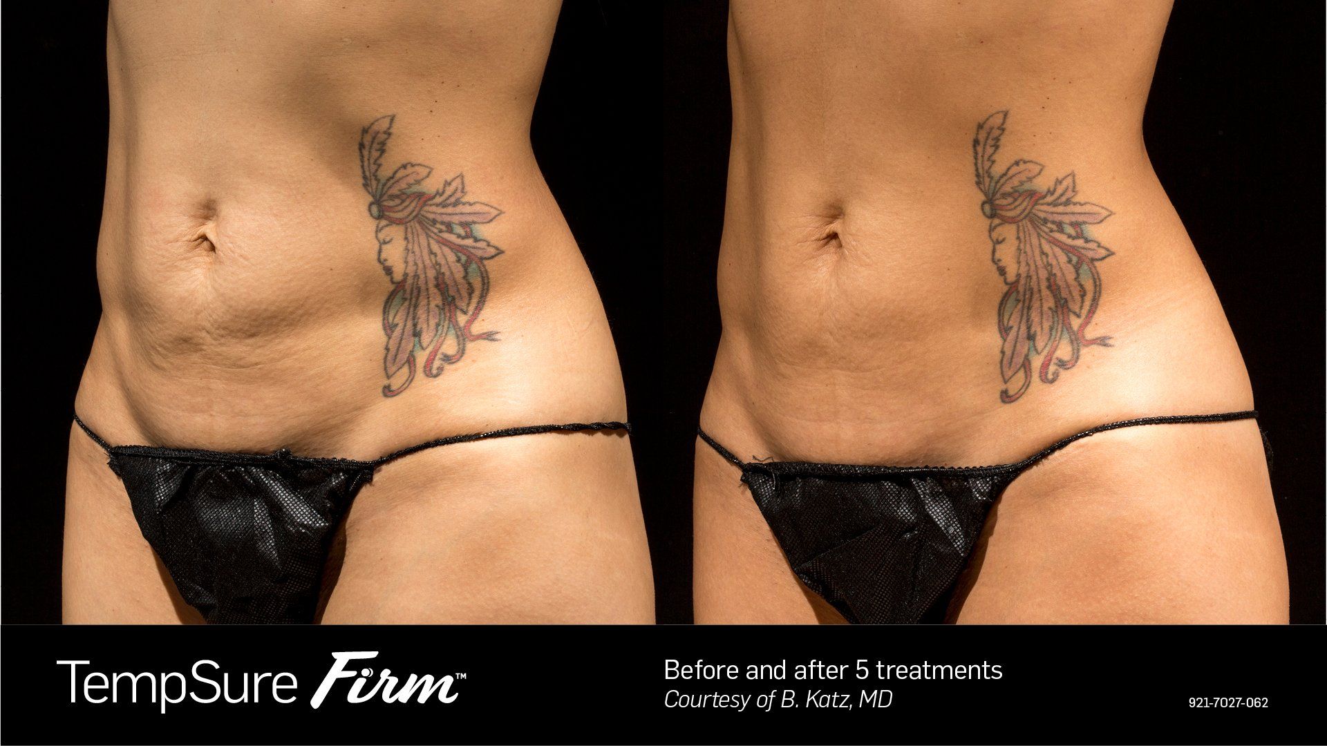 before and after tempsure firm - patient photo