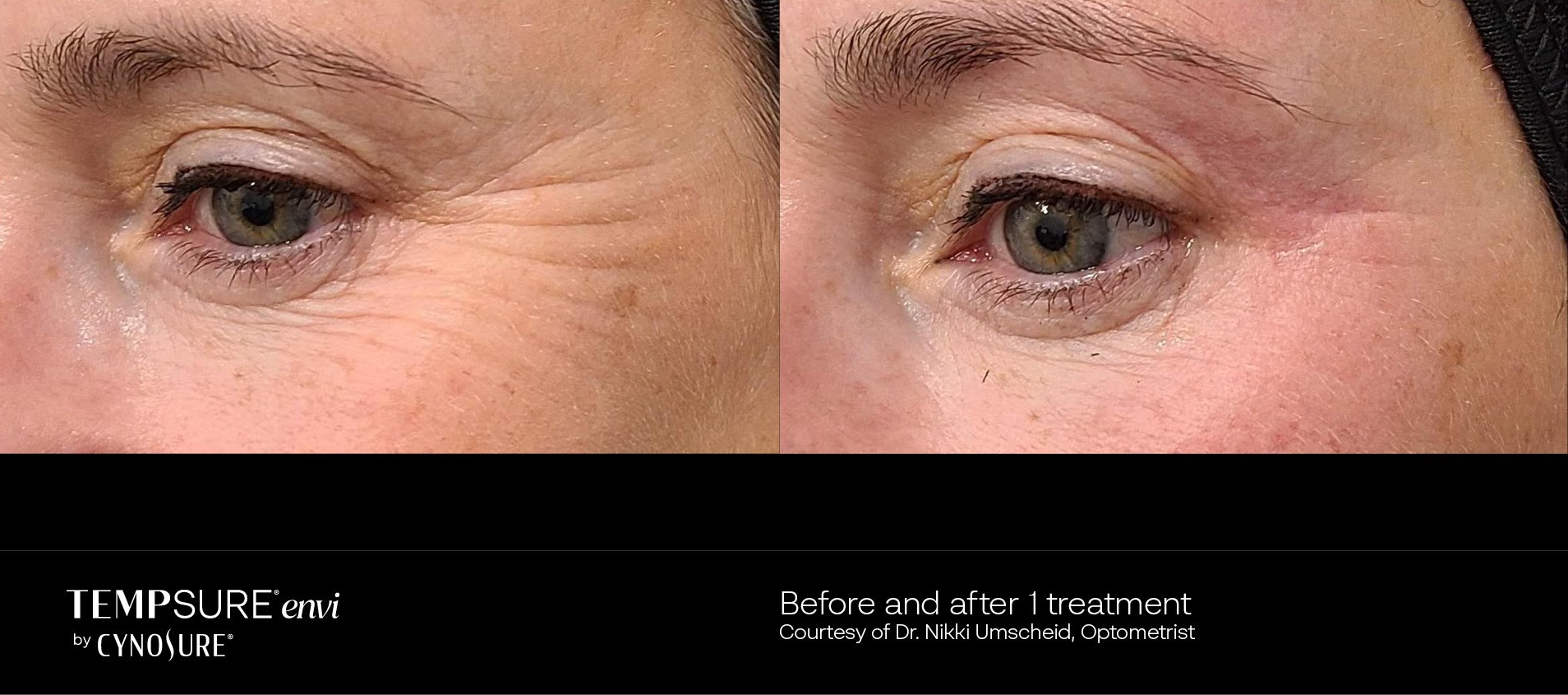 before and after tempsure envi treatment - patient photo