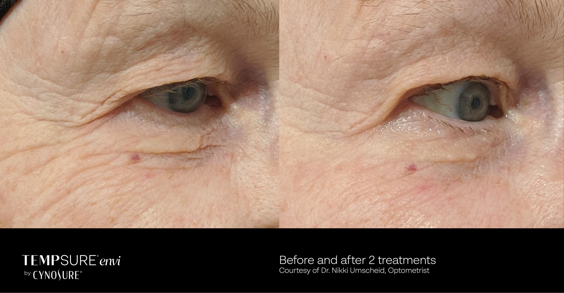 before and after tempsure envi treatment - patient photo