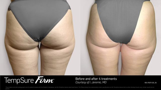 TempSure Firm RF Body Contouring New Jersey, NJ