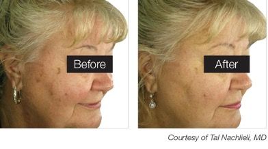 female patient before and after treatment with IPL Photorejuvenation