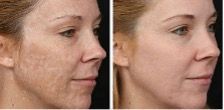 female patient before and after treatment with IPL Photorejuvenation