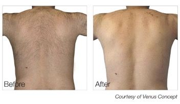 male patient before and after laser hair removal treatment