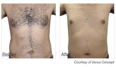 male patient before and after laser hair removal treatment
