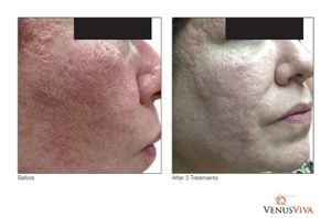 female patient before and after treatment with nanofractional RF microneedling