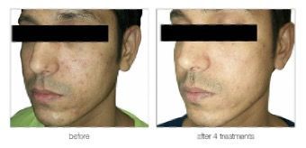 male patient before and after treatment with nanofractional RF microneedling