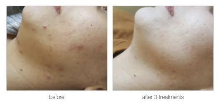 closeup on chin of female patient before and after treatment with IPL for acne