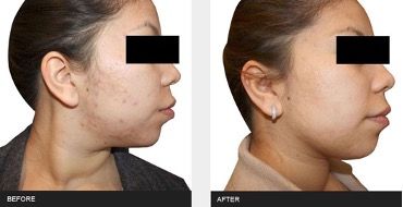 side profile of female patient before and after treatment with IPL for acne