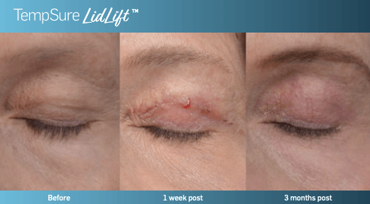 before and after tempsure lidlift - patient photo