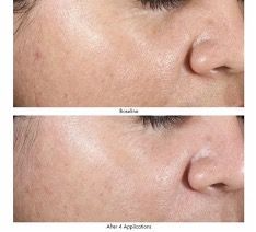 before and after at-home chemical peel