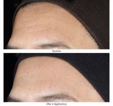 before and after at-home chemical peel