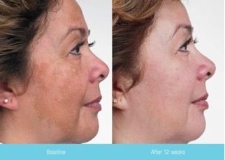 female patient before and after in-office chemical peel