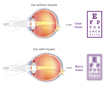 diagram of eye with and eye without myopia