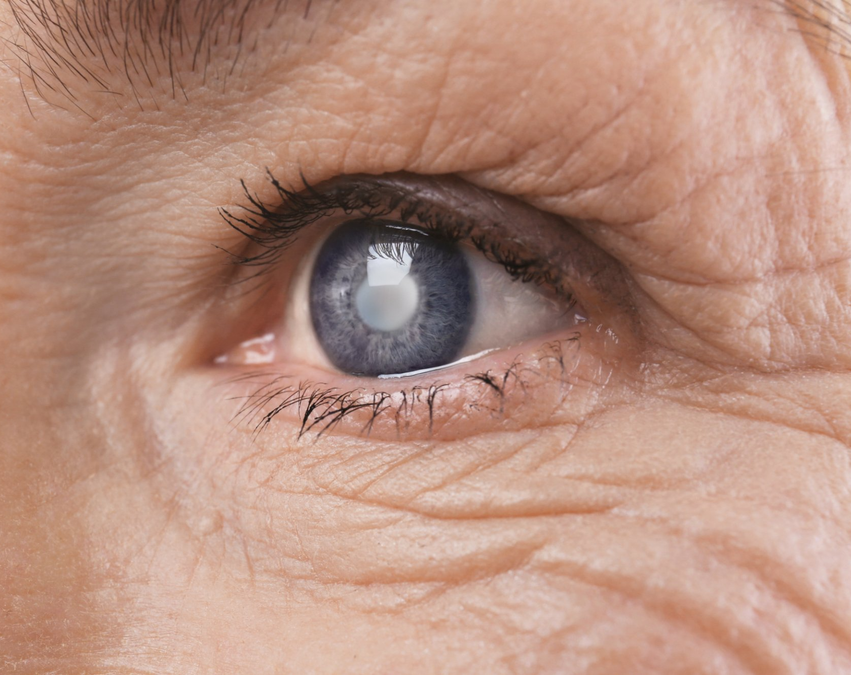 closeup of elderly woman's eye with cataracts